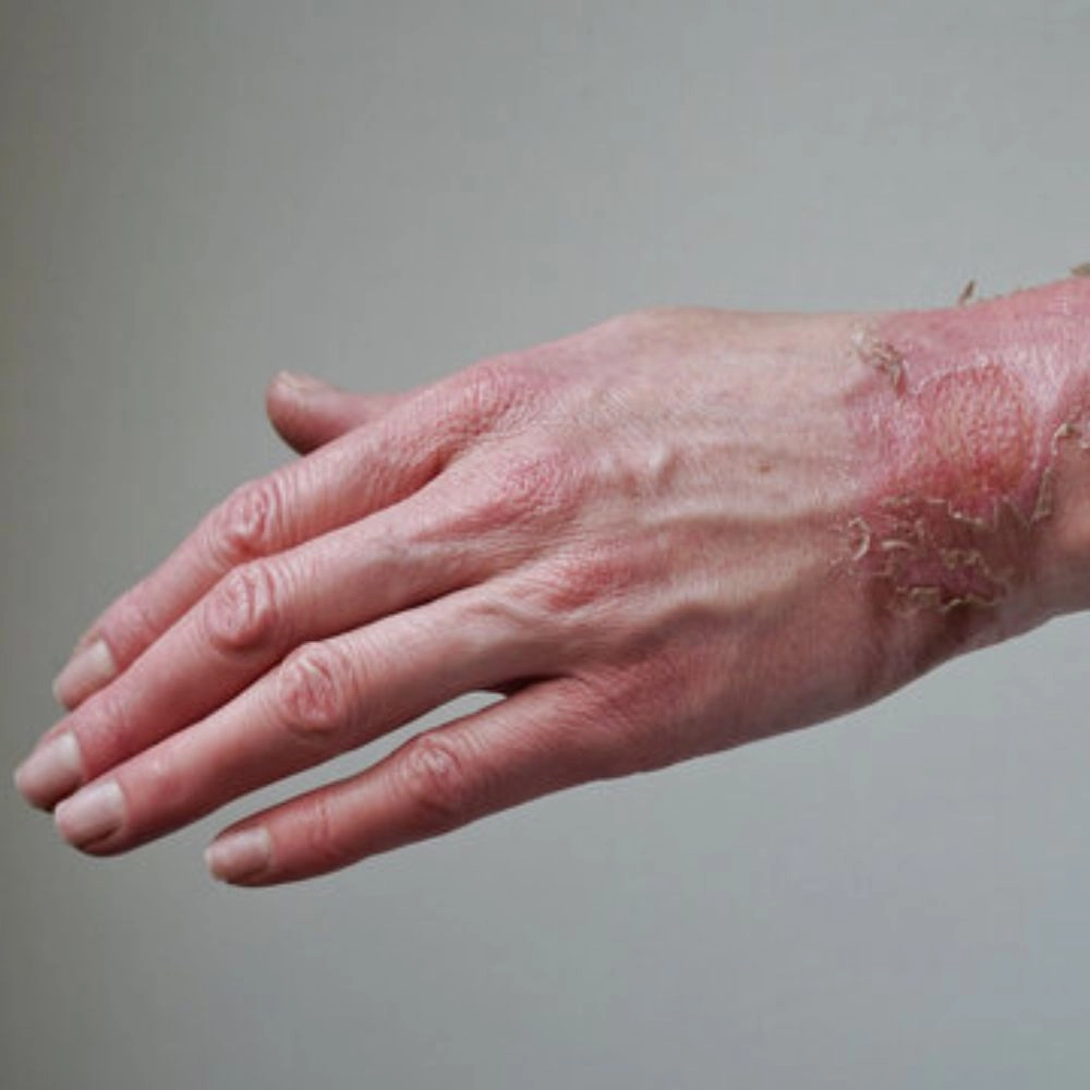 درمان جای سوختگی