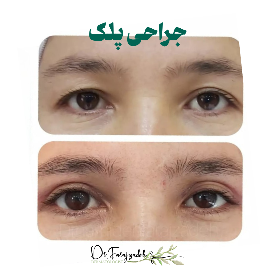 جراحی پلک
