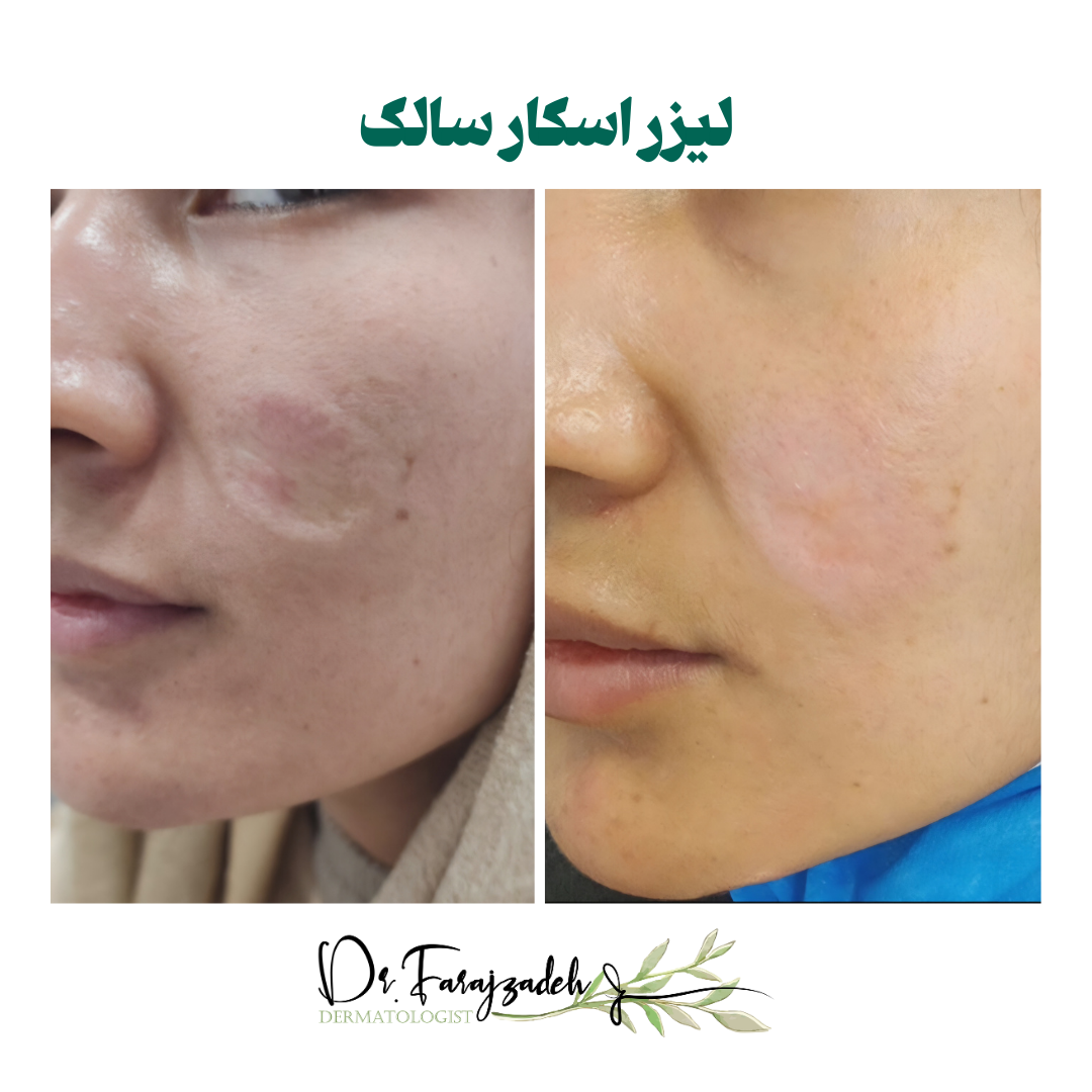 لیزر اسکار سالک