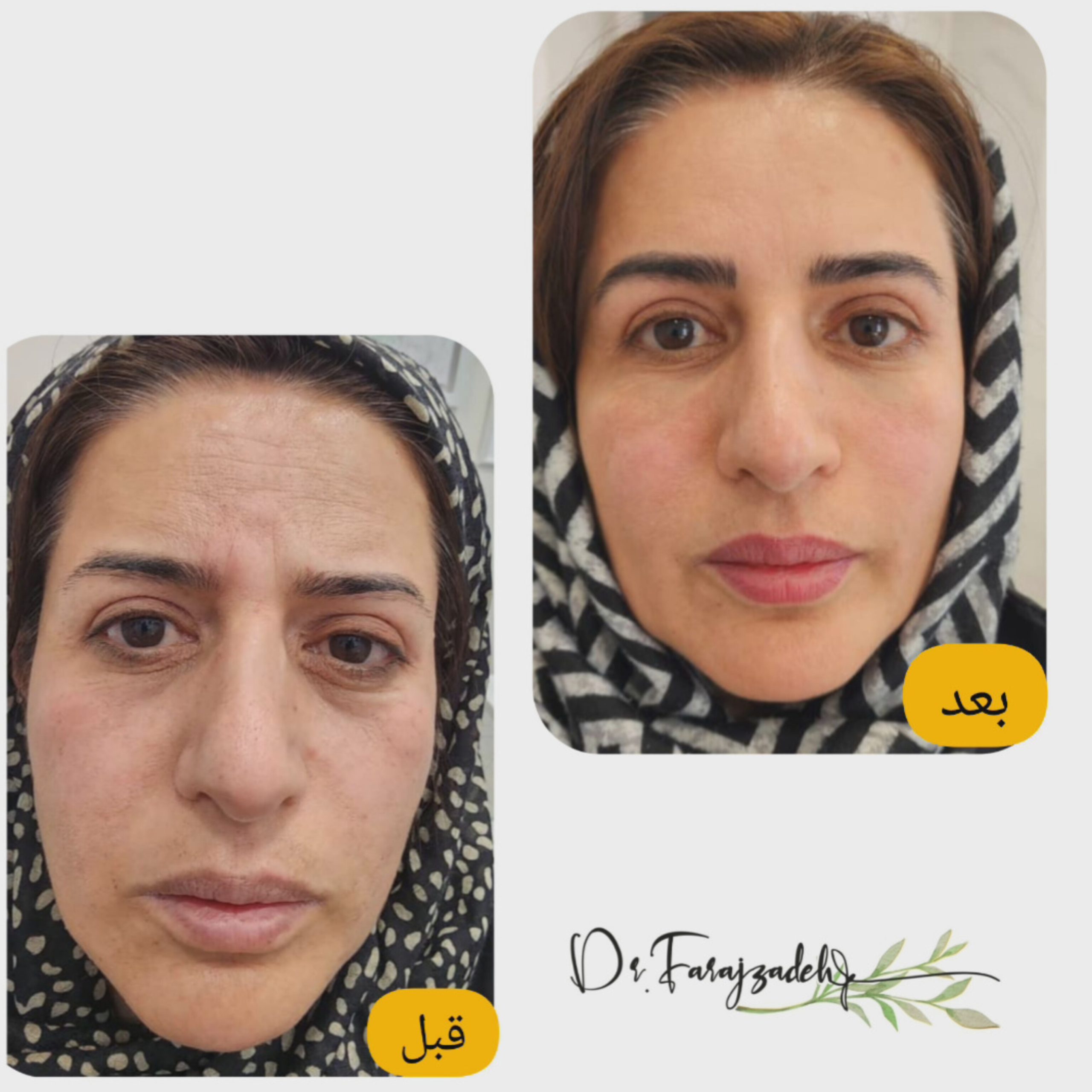 تزریق فیلر و تزریق بوتاکس