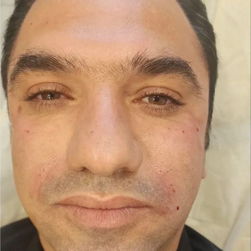 بعد — فیلر خط خنده و زیر چشم