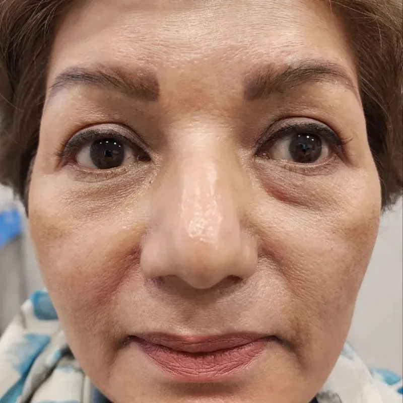 قبل — فیلر خط خنده و زیر چشم