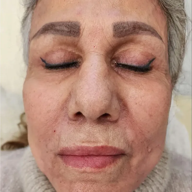 بعد — فیلر خط خنده