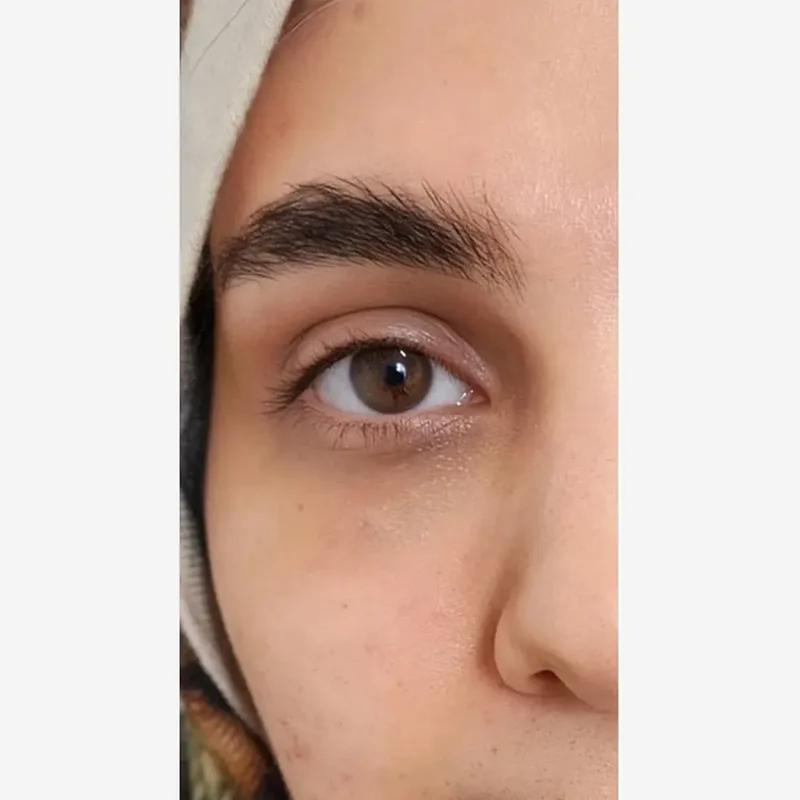 بعد — فیلر زیر چشم