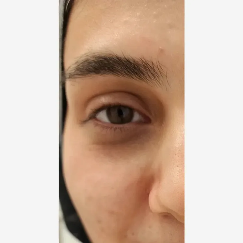 قبل — فیلر زیر چشم