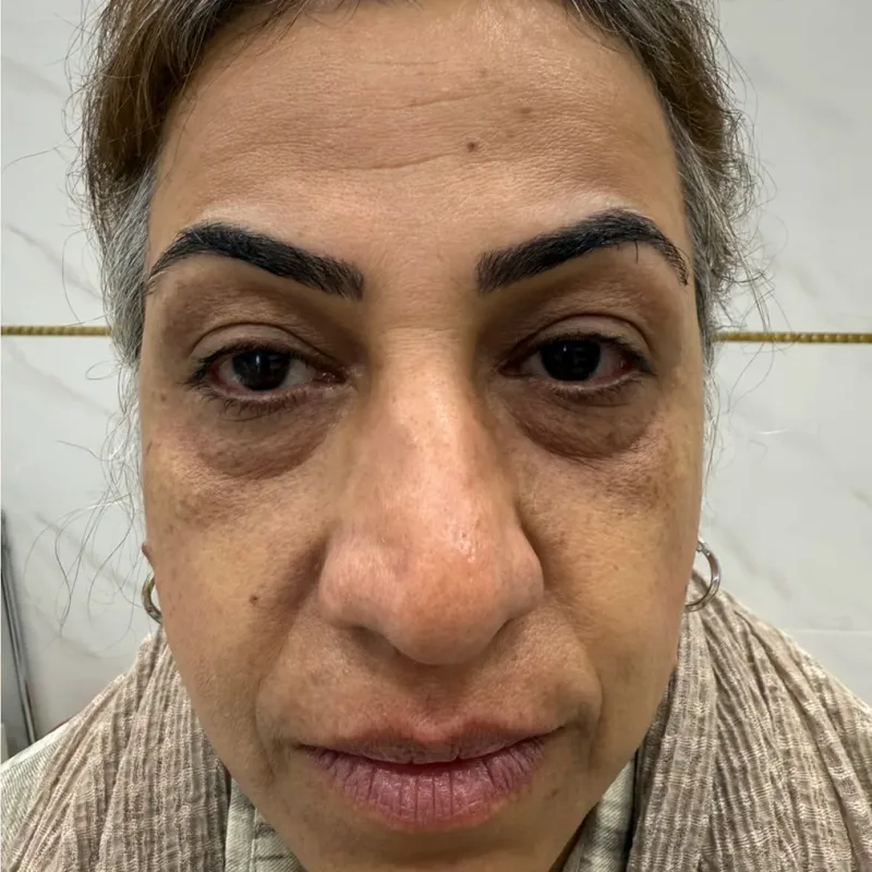 قبل — فیلر زیر چشم