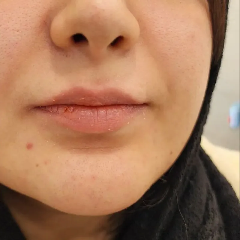 قبل — فیلر لب