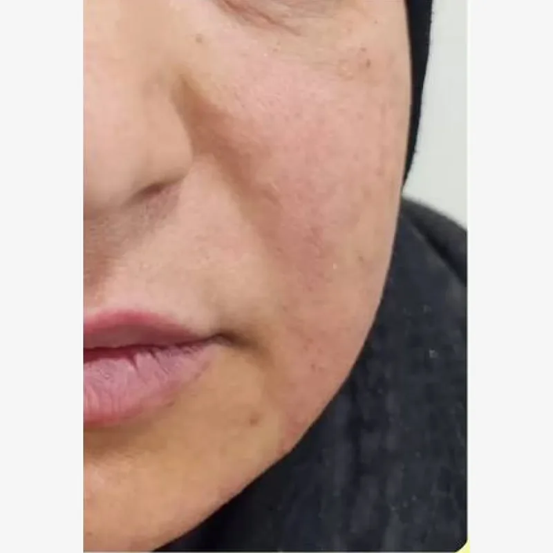 بعد — اندولیفت، گونه