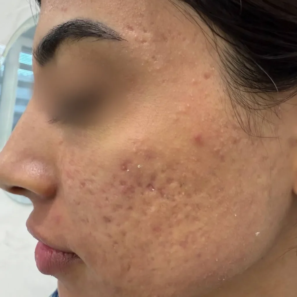 جای جوش فرورفته روی گونه، پیش از لیزر CO2 فرکشنال