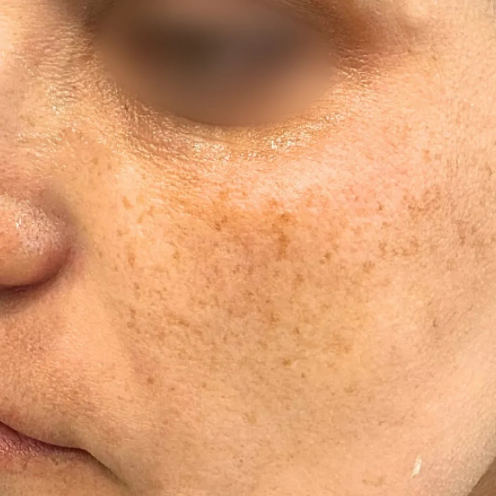 لک و ناهم‌رنگی پوست گونه، پیش از لیزر CO2 فرکشنال