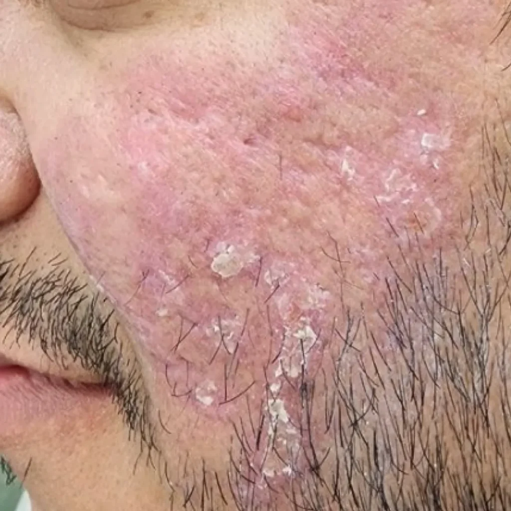 بعد — لیزر اسکار آکنه