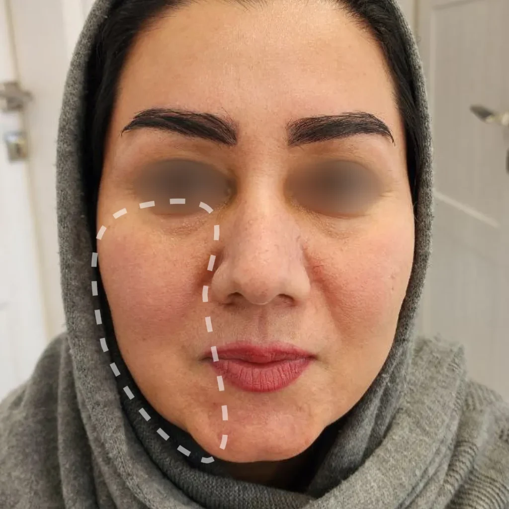 بعد — اندولیفت، گونه، خط خنده و خط فک