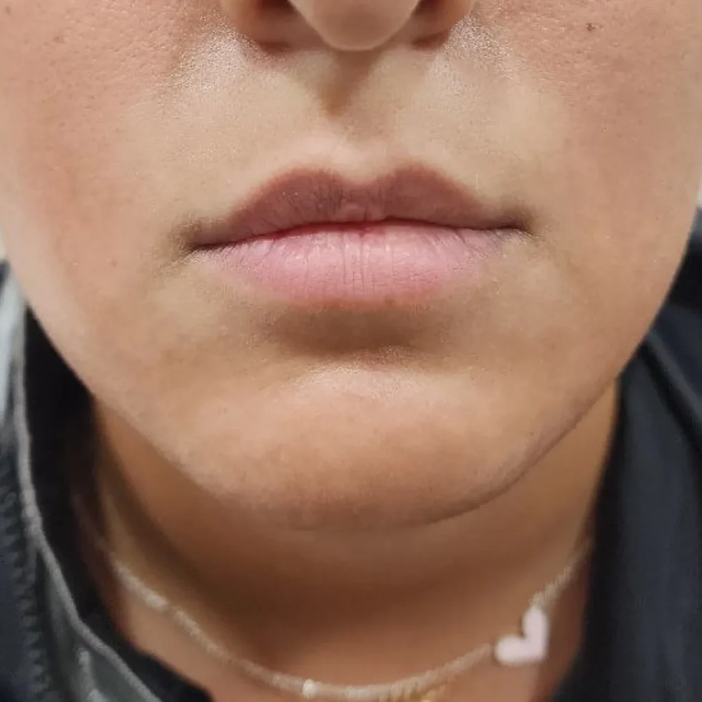 قبل — فیلر لب