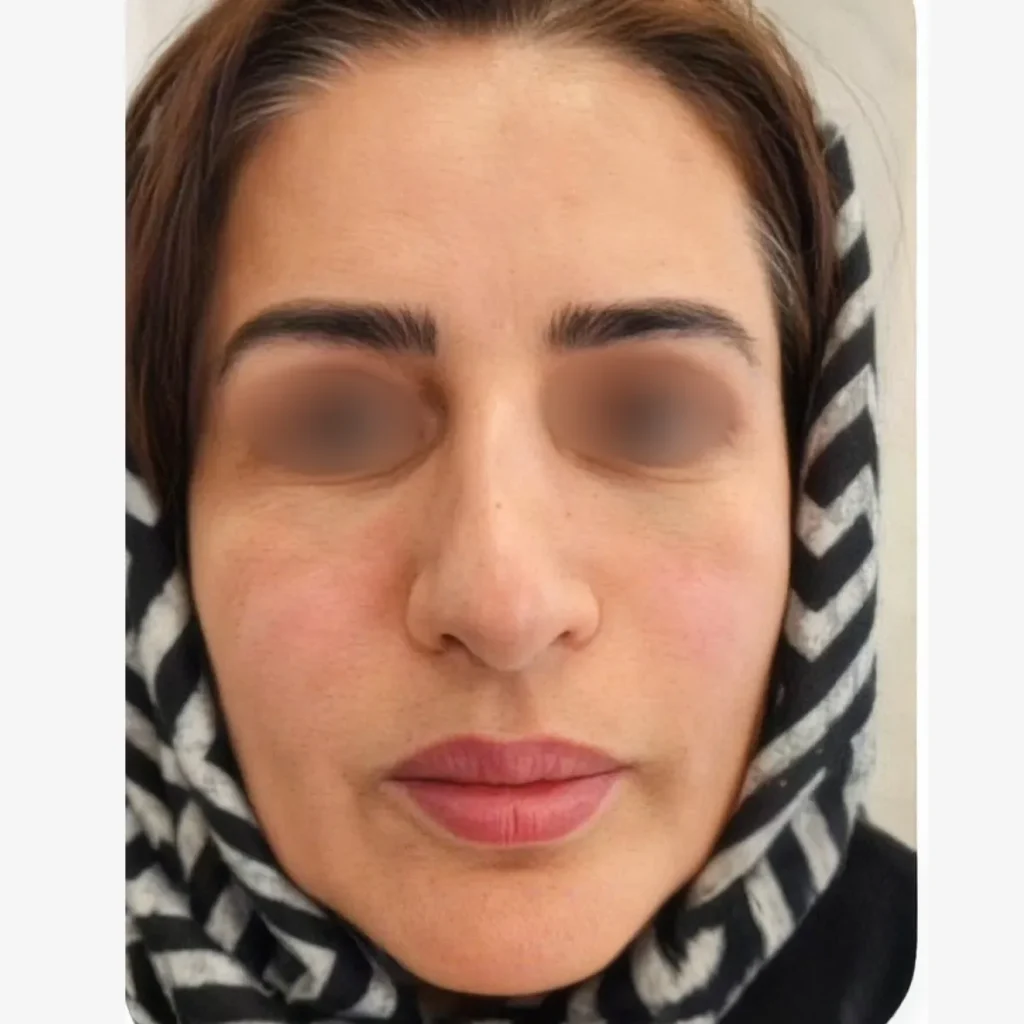 پس از جوان‌سازی پوست با فیلر و بوتاکس