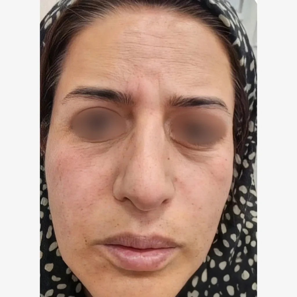 پیش از جوان‌سازی پوست با فیلر و بوتاکس